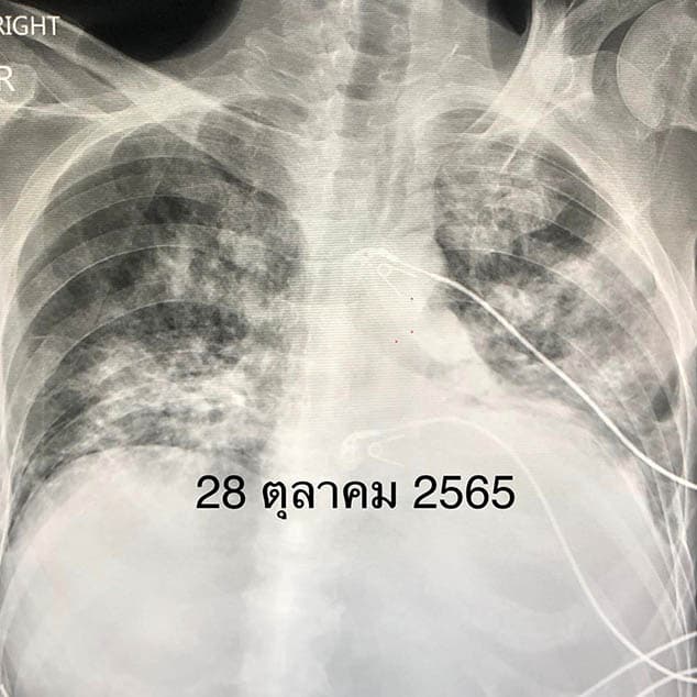Covid_vaccine_saves_lives_of_leukemia_patients_SPACEBAR_Photo02_4acb3e156c.jpeg
