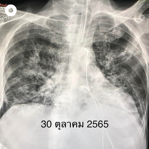 Covid_vaccine_saves_lives_of_leukemia_patients_SPACEBAR_Photo03_8f52563761.jpeg