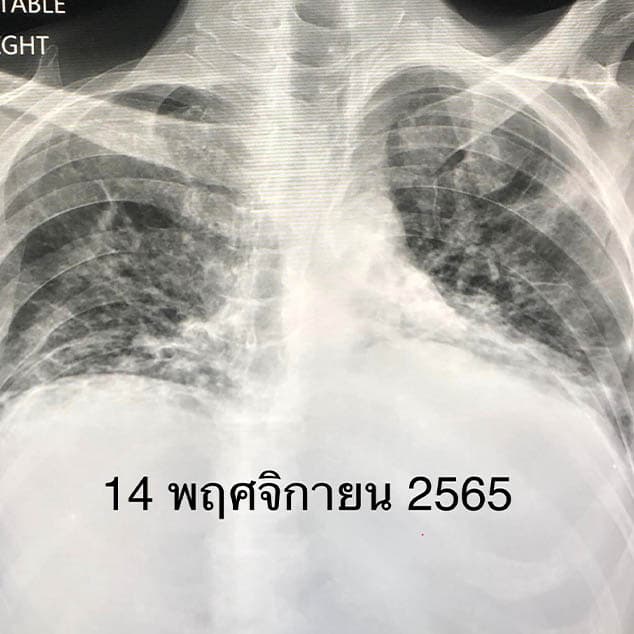 Covid_vaccine_saves_lives_of_leukemia_patients_SPACEBAR_Photo04_af24fc4029.jpeg
